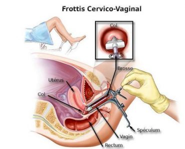 Un frottis vaginal