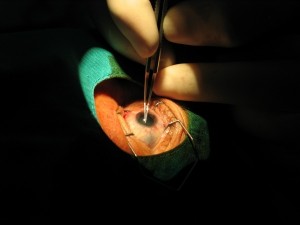 Cataracte-chirurgie-œil