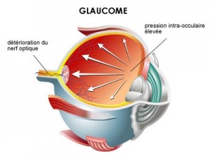 Glaucome-infographie