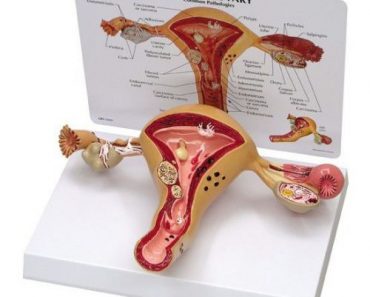 Utérus pathologique